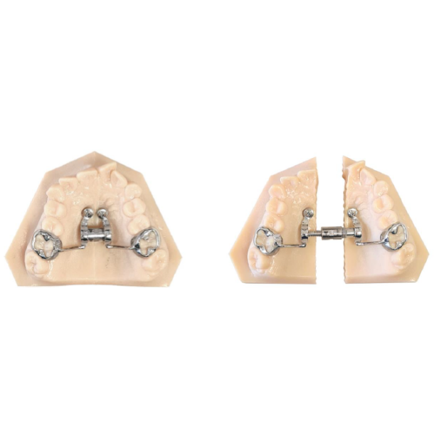 Cad-Cam Telescopic Expander 10 -14 -18 mm