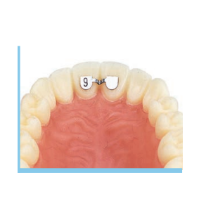 RETAINERS UPPER CEN/CEN 6mm